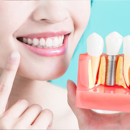 Dental Implants